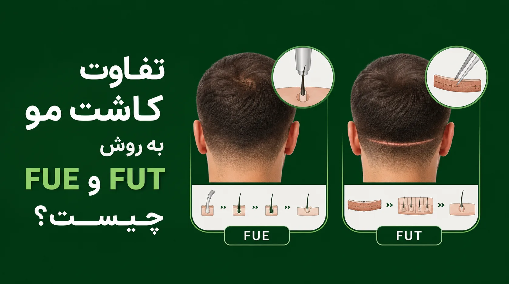 تفاوت کاشت مو به روش FUE و FUT چیست؟